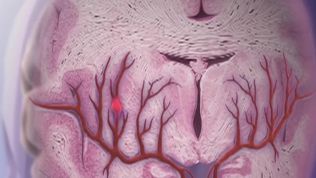 Knowing the signs of a stroke can save lives — Roswell Community news
